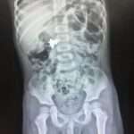 Series Of X-Rays Monitors ‘Flight’ Of Toy Jet Through Small Boy’s Digestive…