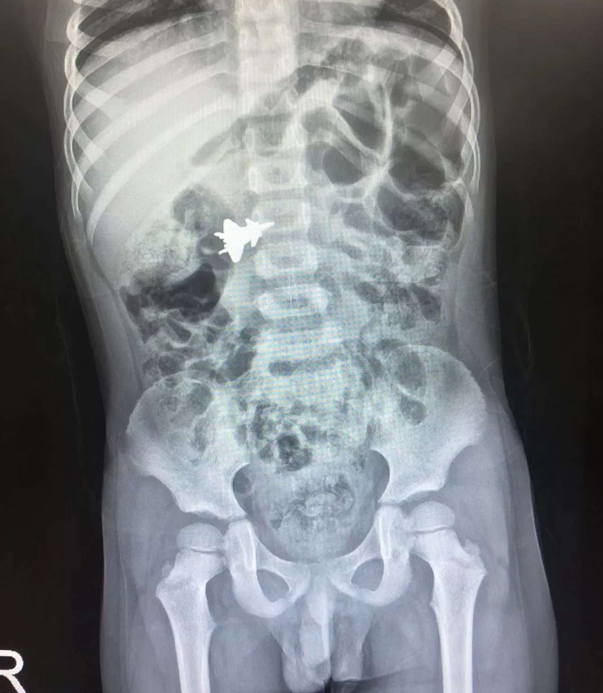 Read more about the article Series Of X-Rays Monitors ‘Flight’ Of Toy Jet Through Small Boy’s Digestive System