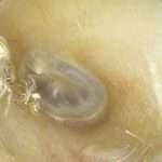 Woman Finds Spider And Its Molted Skin Inside Her Ear After Losing…